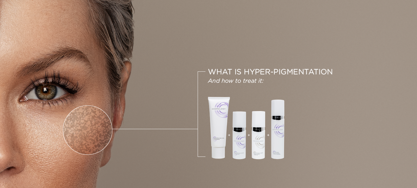What is Hyperpigmentation and how to treat it